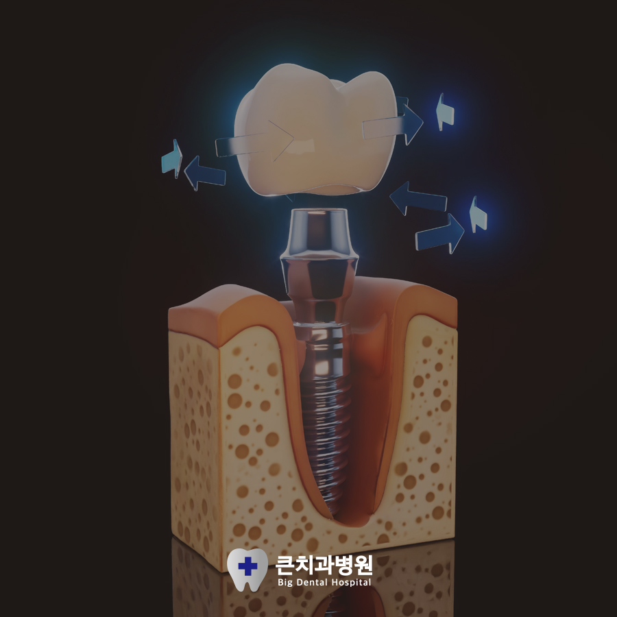 울산북구전악임플란트