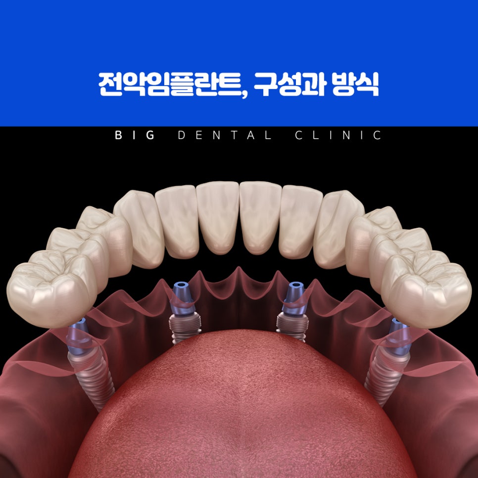 울산북구전악임플란트