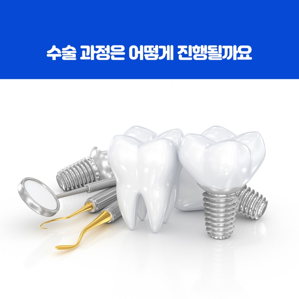 울산북구전악임플란트