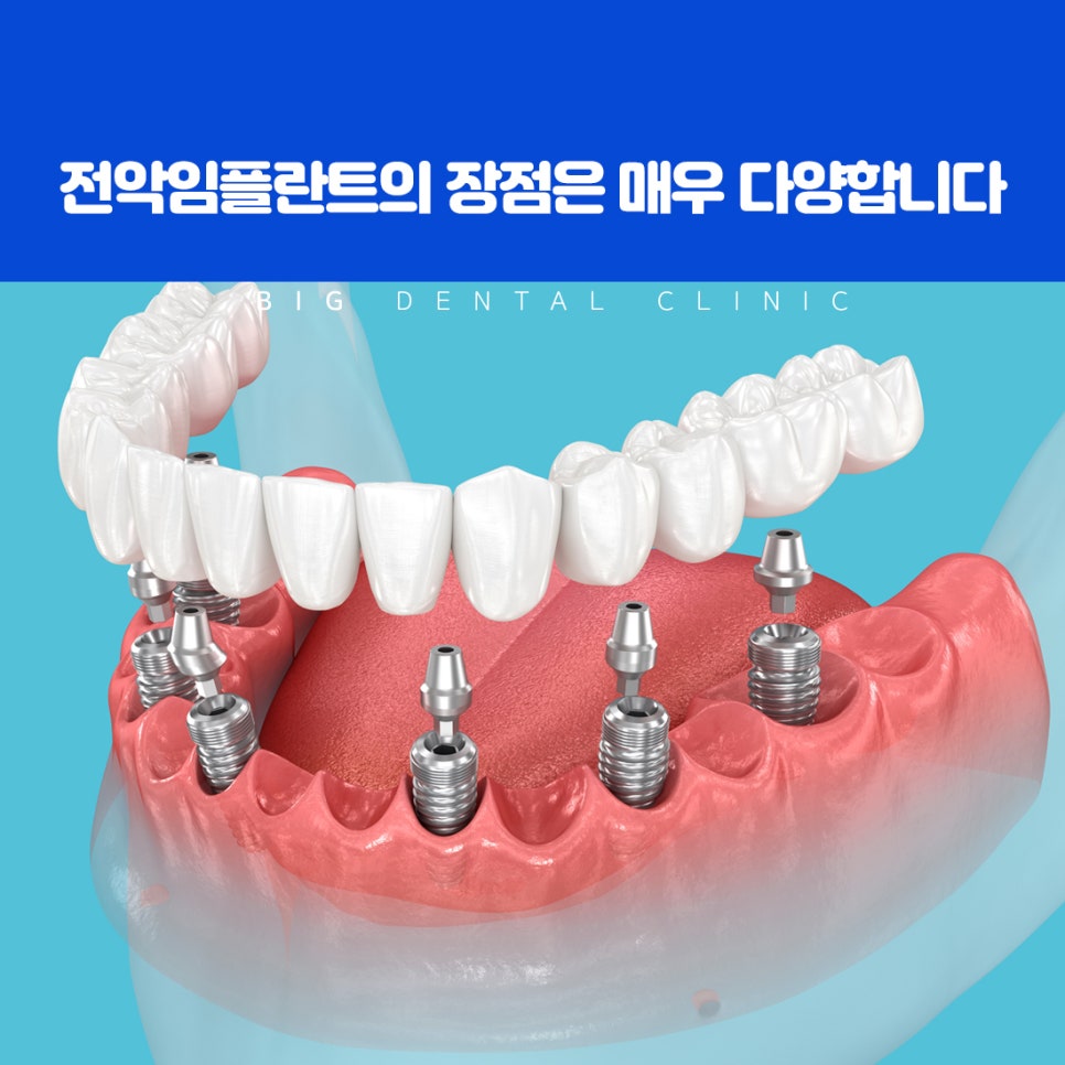 울산북구전악임플란트