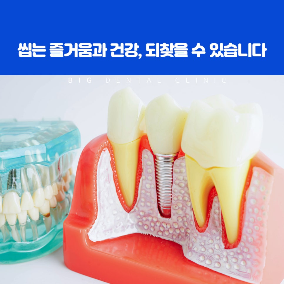 울산북구전악임플란트