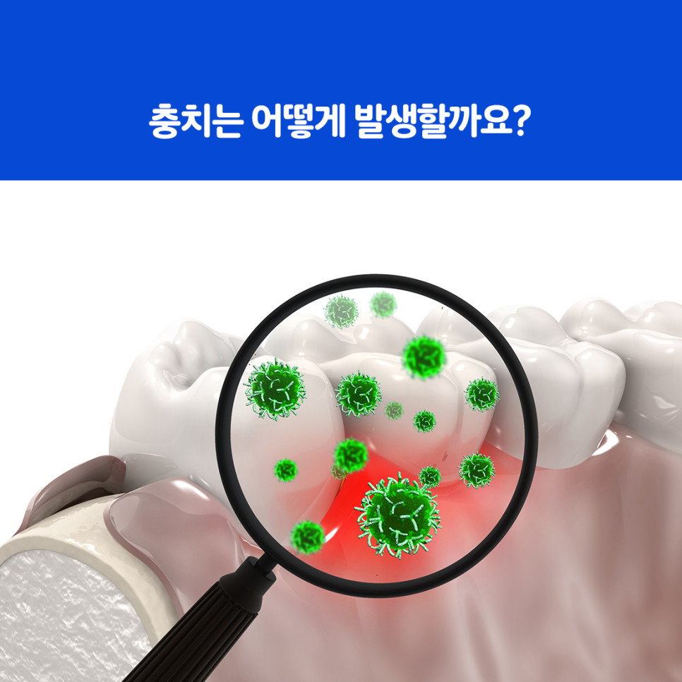 울산북구치과 양치질과 치실 사용을 미룰 때 커지는 충치 초기 위험 주의사항