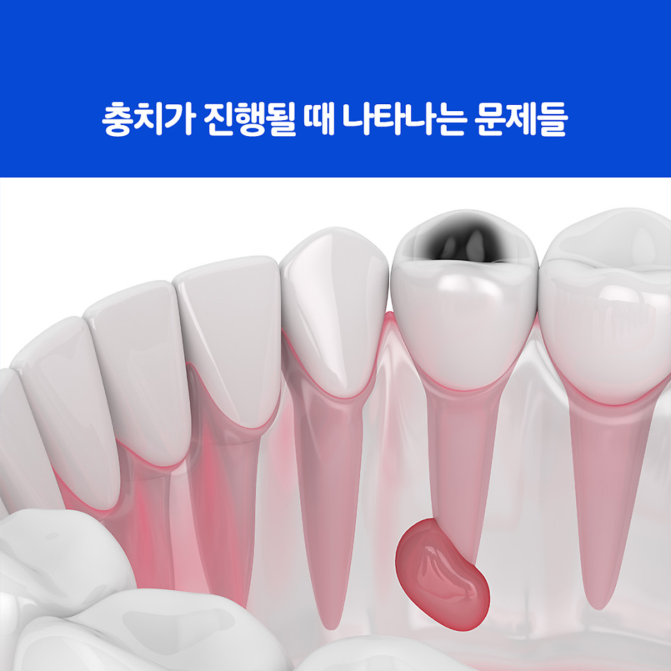 울산북구충치치료