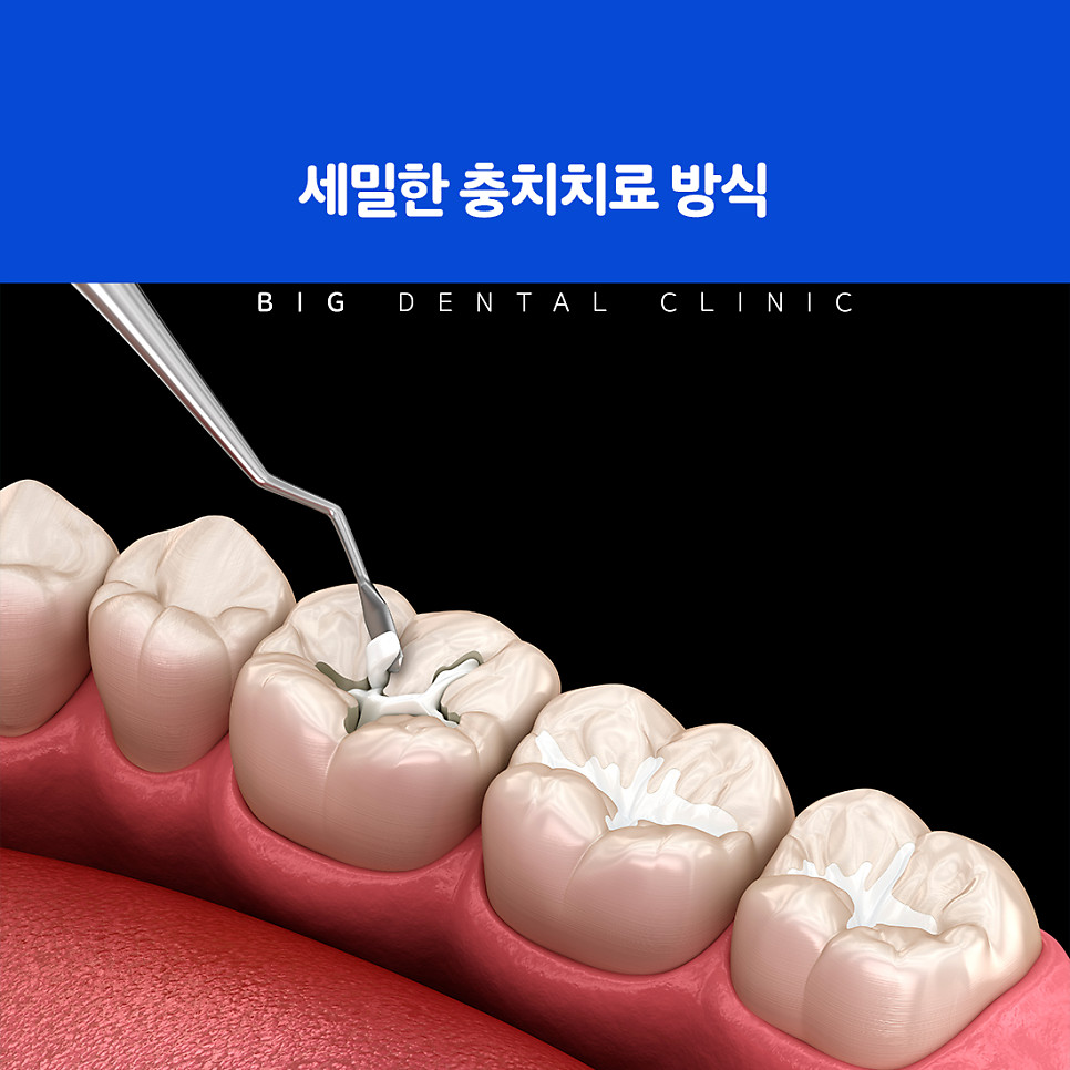 울산북구충치치료