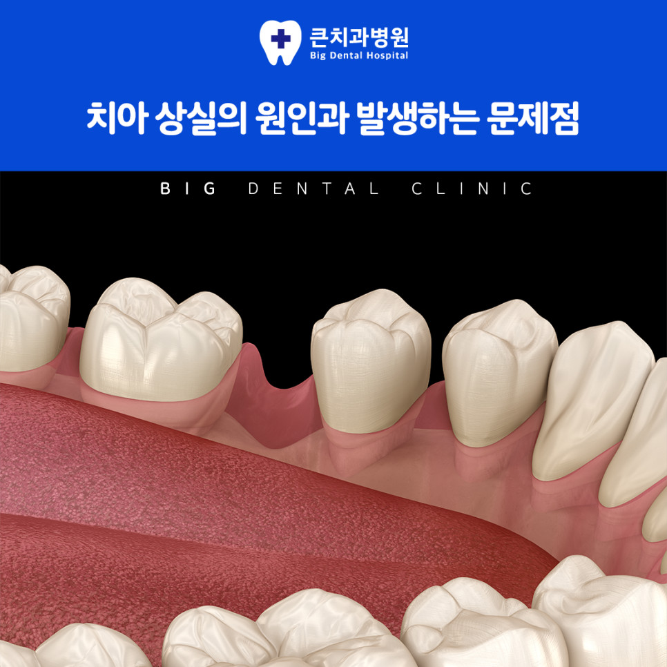 울산북구치과 임플란트 인공 치근 식립 후 크라운 부착 치료 방법과 자연치 대체 과정