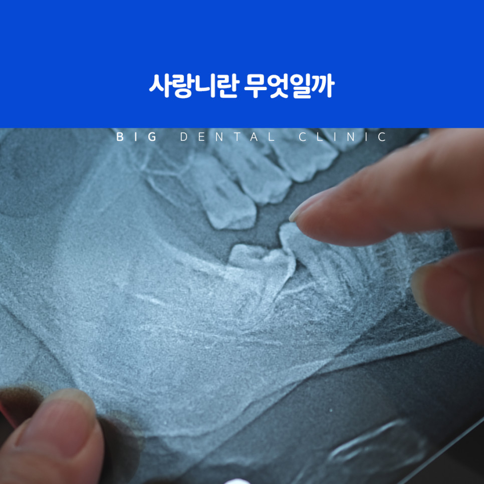 울산북구치과 제삼대구치 사랑니 위치와 십대 후반 맹출 시기 확인 방법 정리