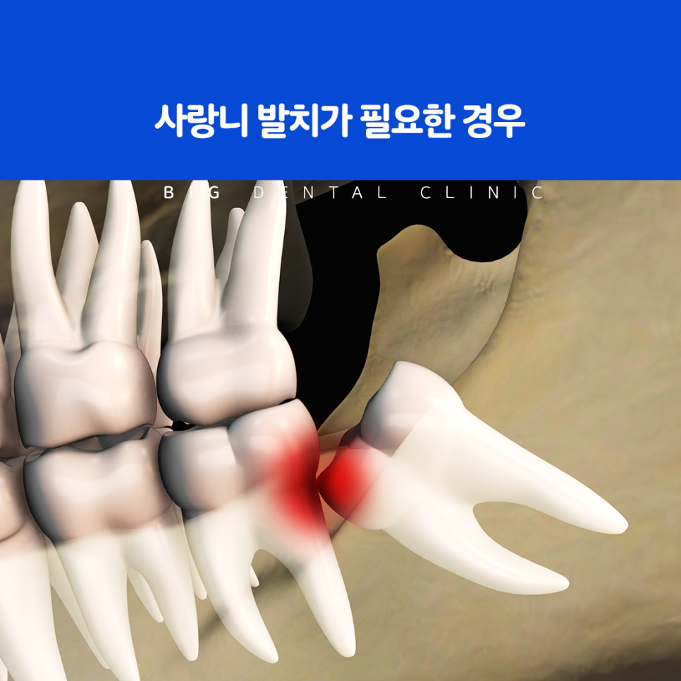 울산북구치과 사랑니 무조건 발치 여부와 개별 판단 기준과 필요성 확인 방법