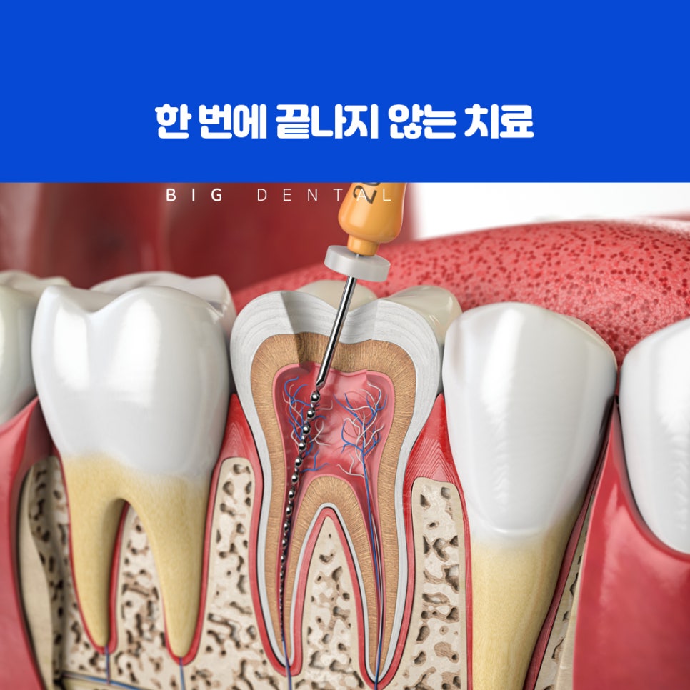울산북구신경치료 깊은 충치와 외부 충격 후 극심한 통증 신호