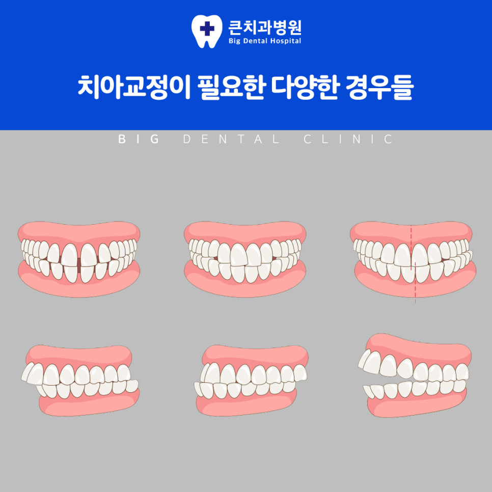 울산북구치과 치아교정의 턱 조화 저작 발음 회복 효과