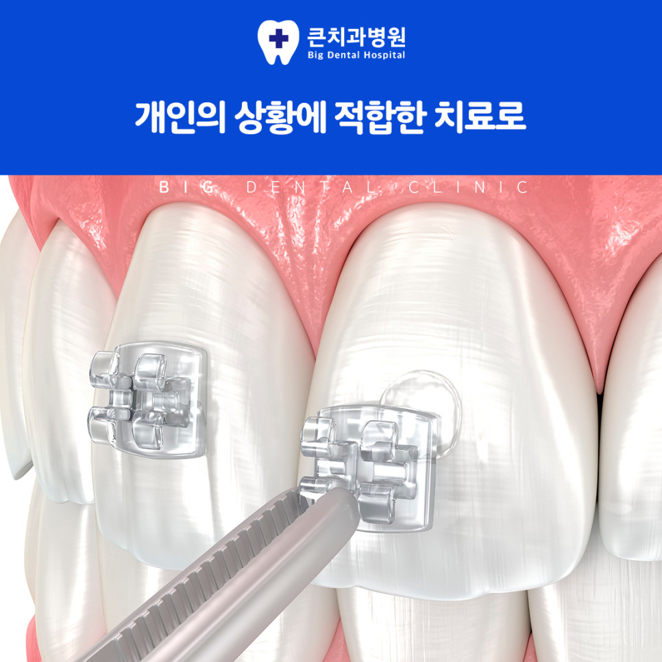 울산북구치과 윗니와 아랫니 맞물림 문제 교정 이유