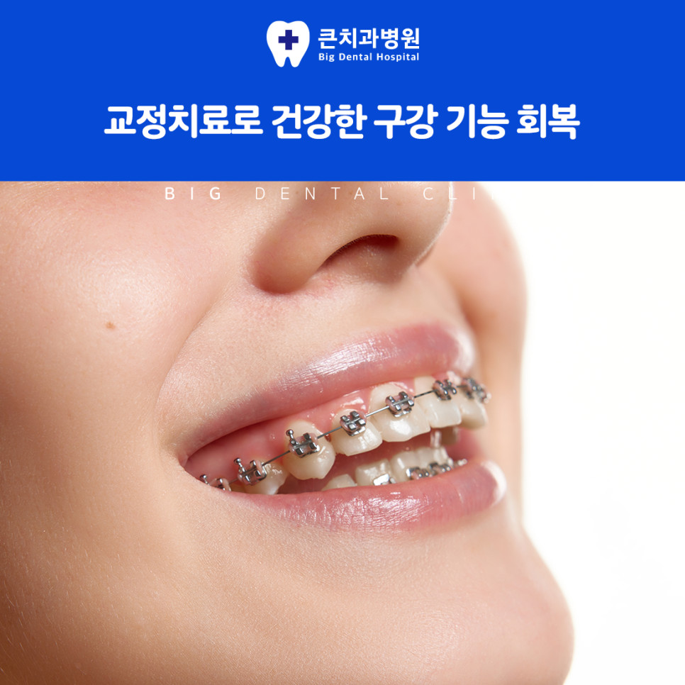 울산북구치과 성인 치아교정의 기능과 심미 개선점