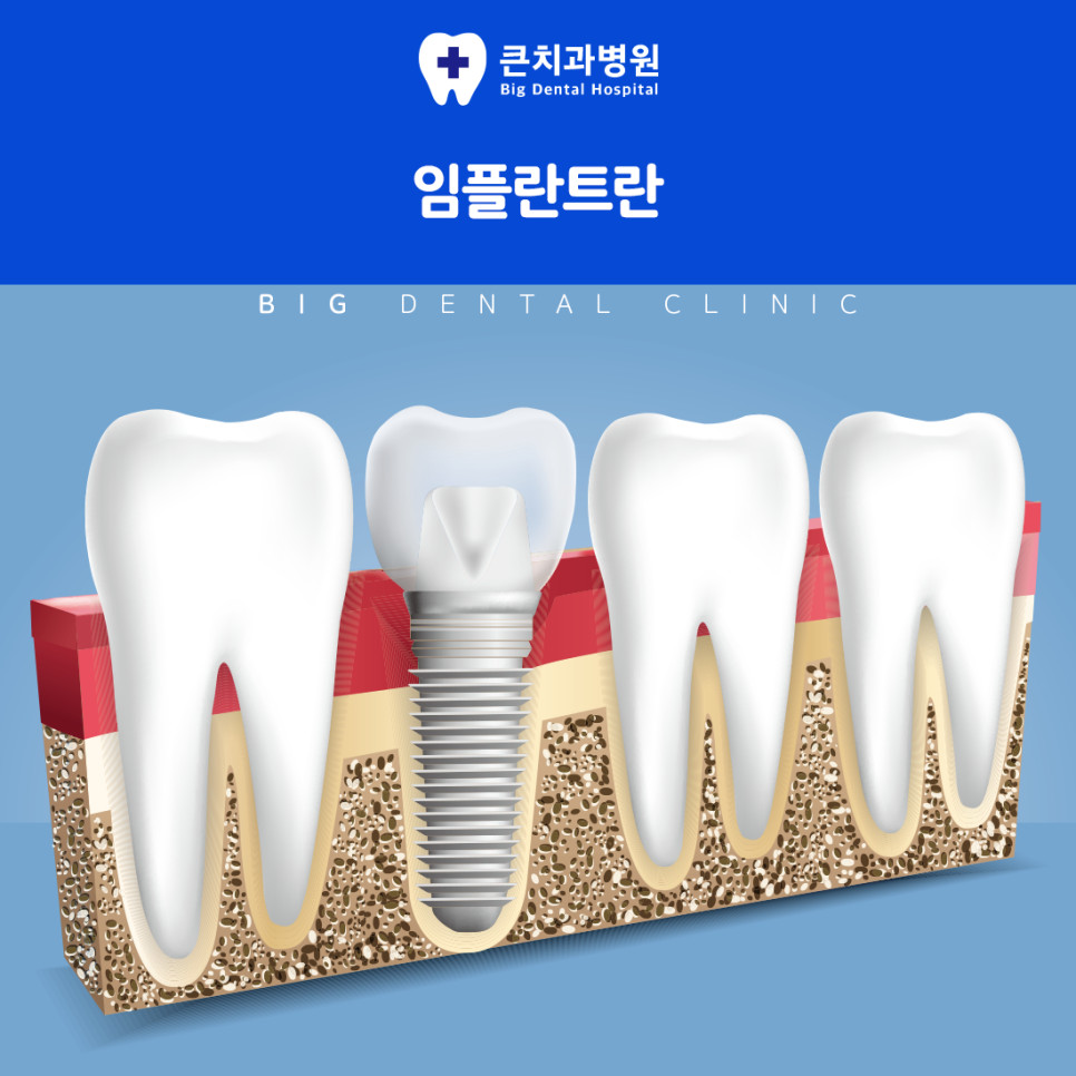 울산북구치과 기능과 심미성을 함께 고려한 임플란트 치료 추천 핵심 선택 기준