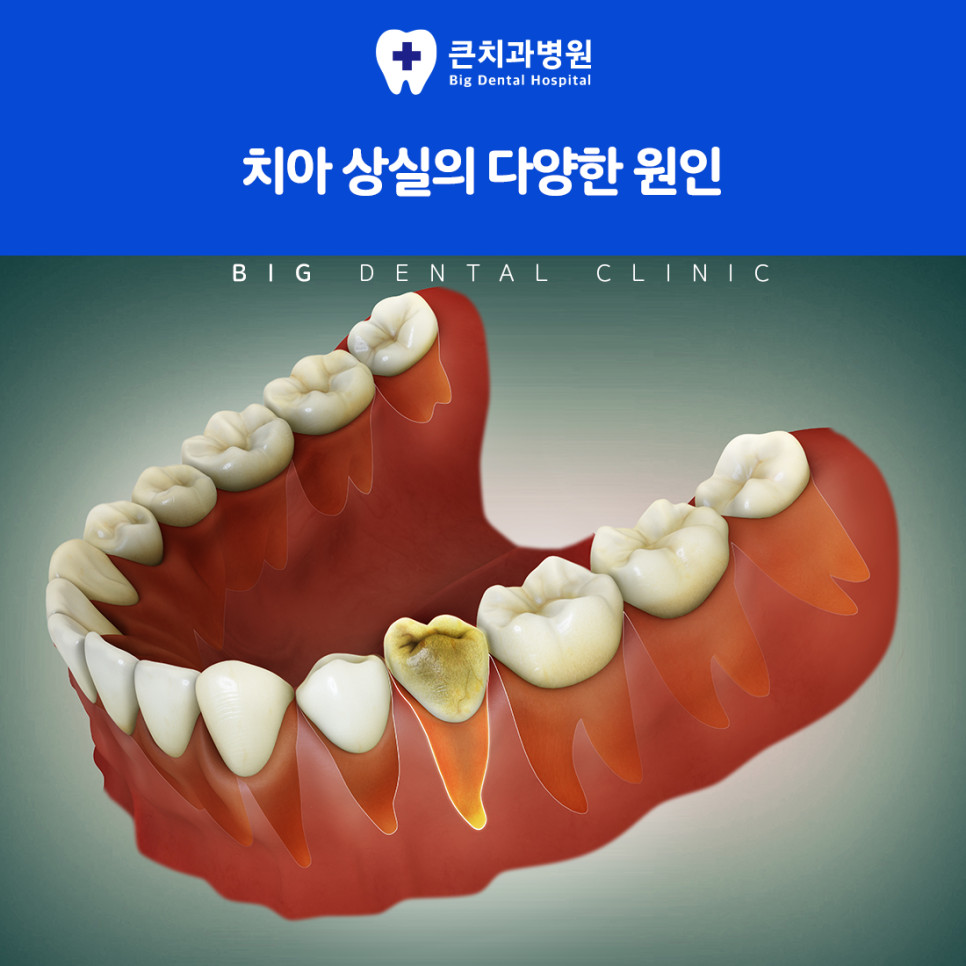 울산북구치과 상실 치아 기능 회복을 위한 인공 치아 임플란트 방법 기본 원리
