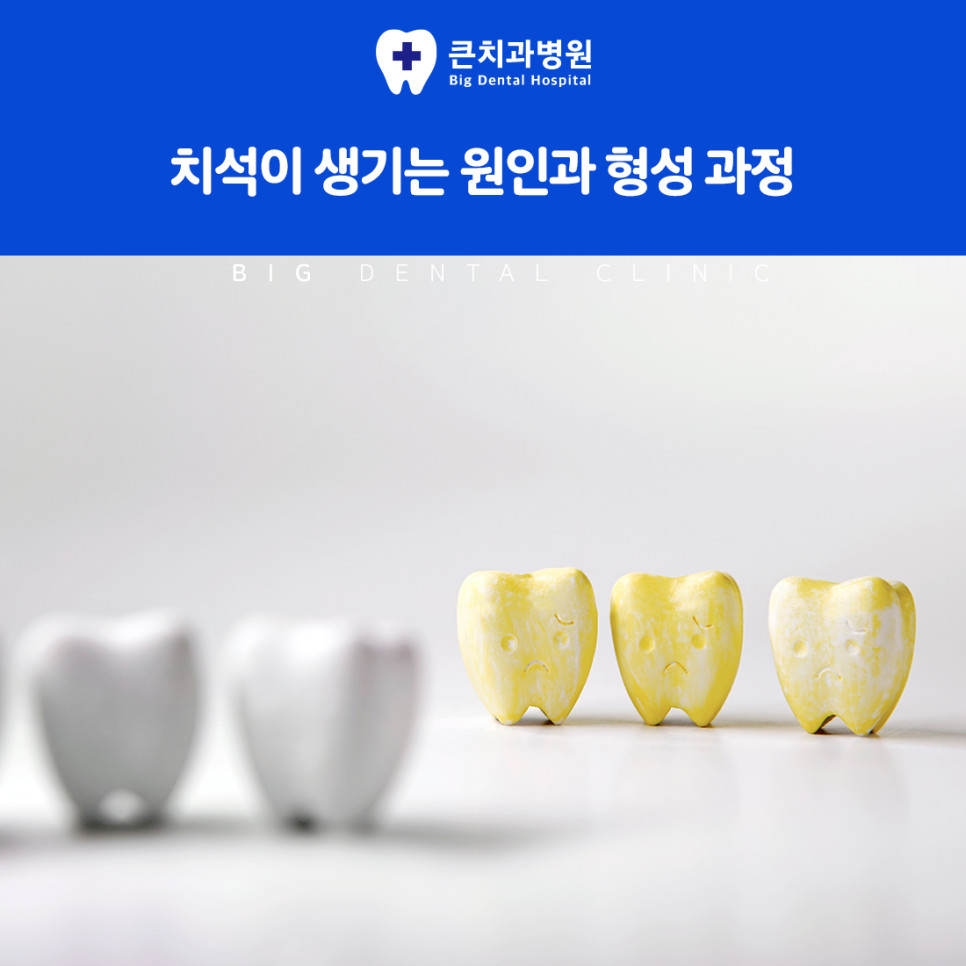 울산북구스케일링 치석 제거 전 치아 표면 음식물 찌꺼기와 세균이 시간이 지나 굳는 과정
