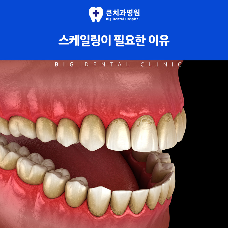 울산북구스케일링 치석 원인인 부족한 양치 습관과 치실 미사용 치태 축적 주의사항