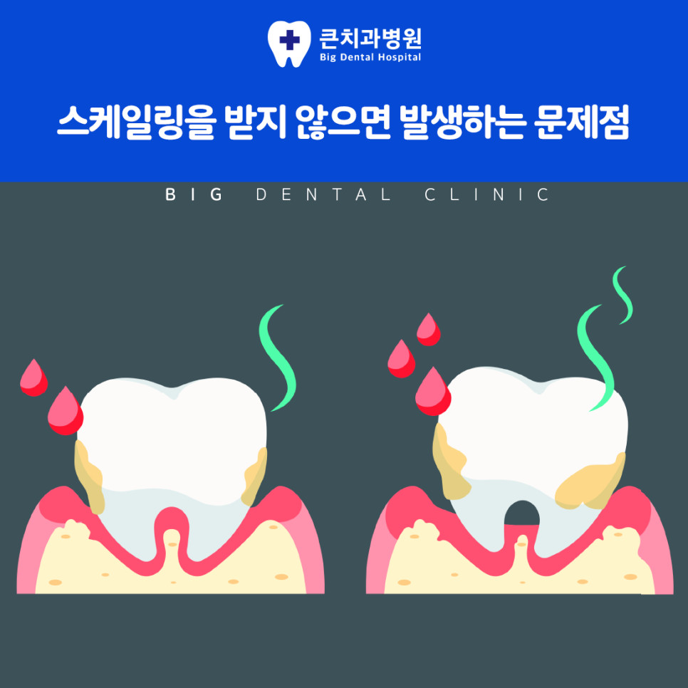울산북구스케일링 치석 형성을 쉽게 하는 자주 반복되는 당분 섭취와 흡연 습관 주의사항
