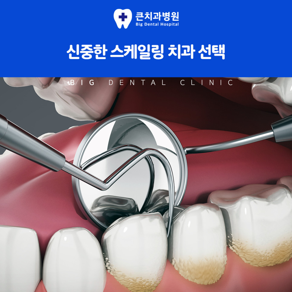 울산북구스케일링 양치로 제거하기 어려운 치아 사이 치석의 효율적인 정기 관리 방법