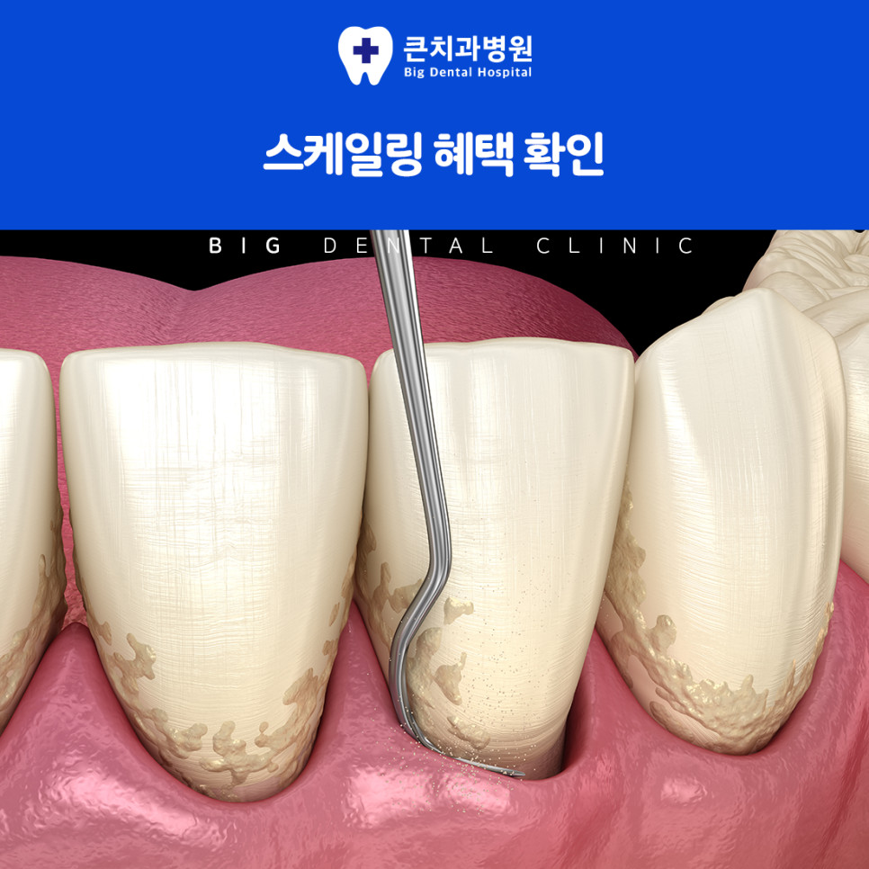 울산북구스케일링 아무리 양치질해도 치아 사이사이 남은 치석 제거가 어려운 이유