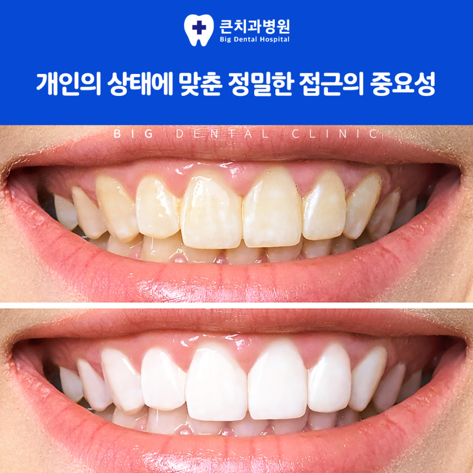 울산북구치과 치아미백으로 본래 밝은 색을 되찾는 선택 방법