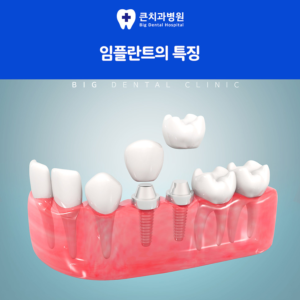 울산북구치과 임플란트 확인할 점 음식 씹는 편의성과 삶의 만족도 좌우 기준