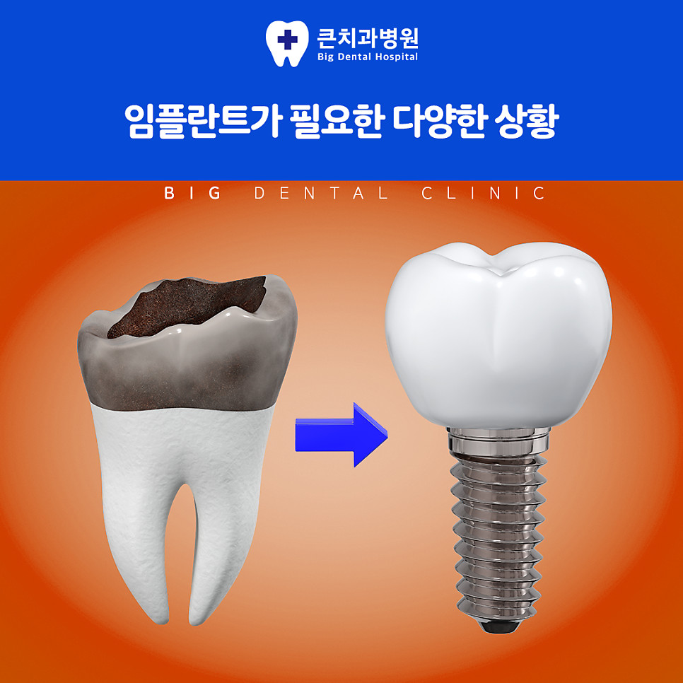 울산북구치과 임플란트 방법 잇몸 뼈 식립 인공치아 구조물 자연치아 역할 대체