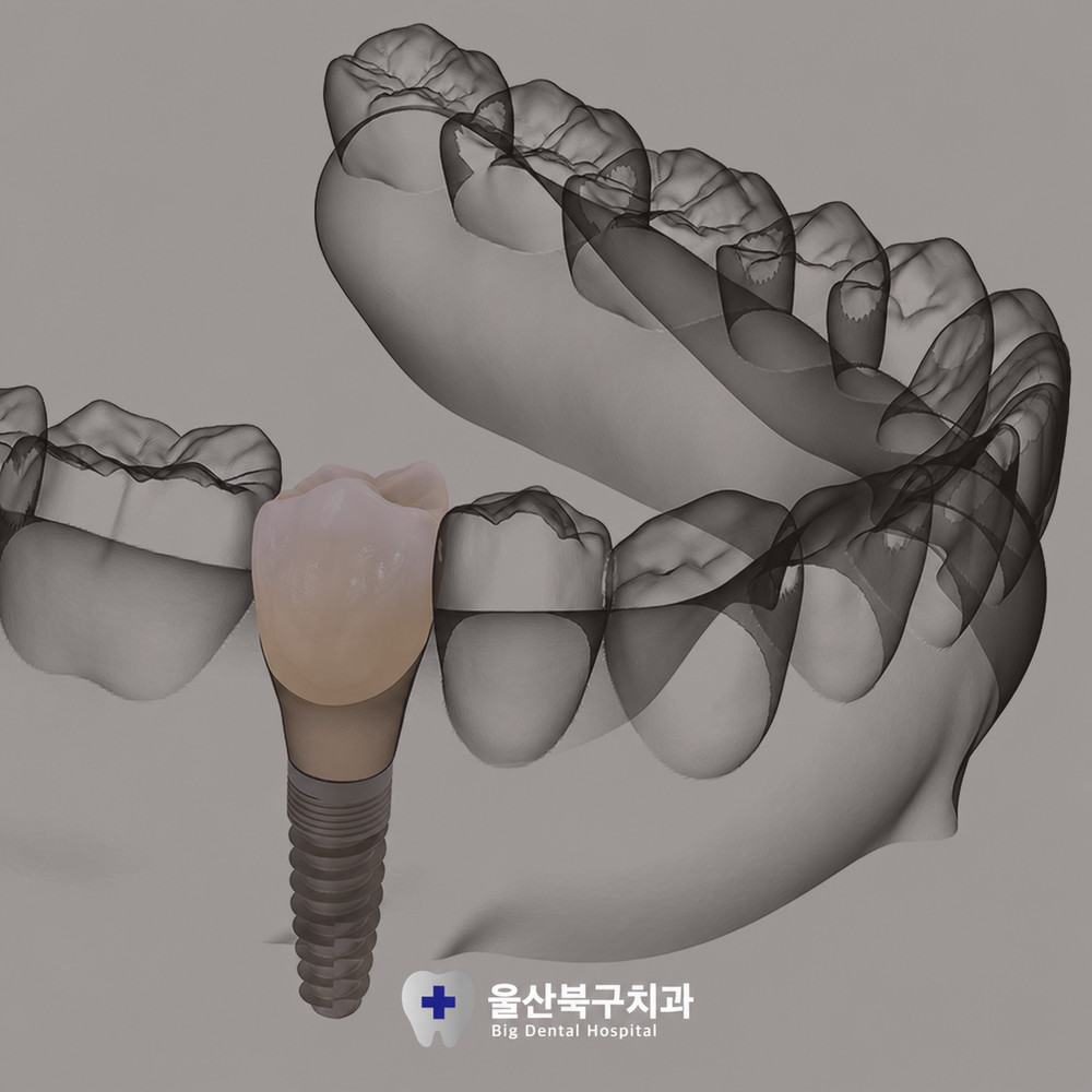 울산북구치과 치아 상실 후 저작력 저하와 얼굴 변화까지 생기는 조기 대체 주의사항