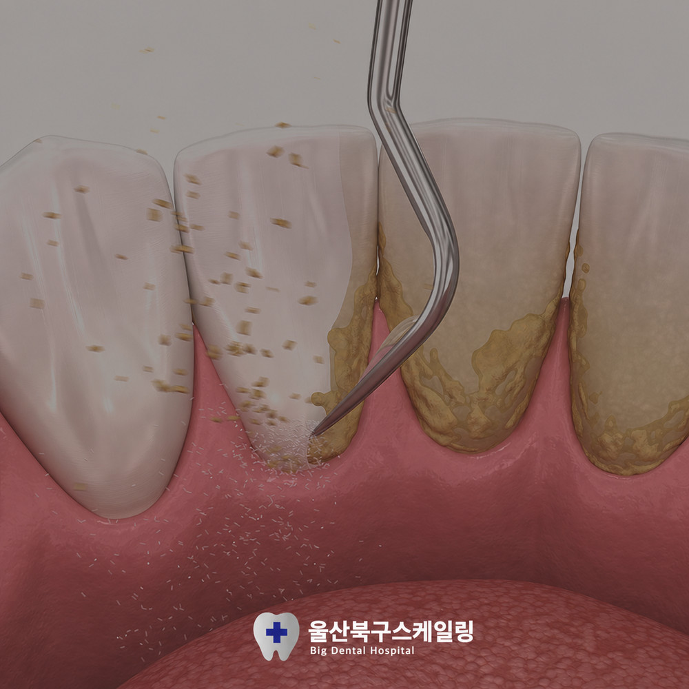 울산북구스케일링 정기 관리가 미소 자신감과 간과하기 쉬운 구강 건강에 필요한 이유