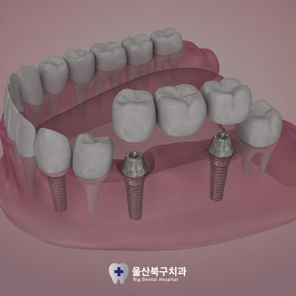 울산북구치과 임플란트 추천 치아 상실 후 자연치아처럼 씹는 감각 회복 선택지