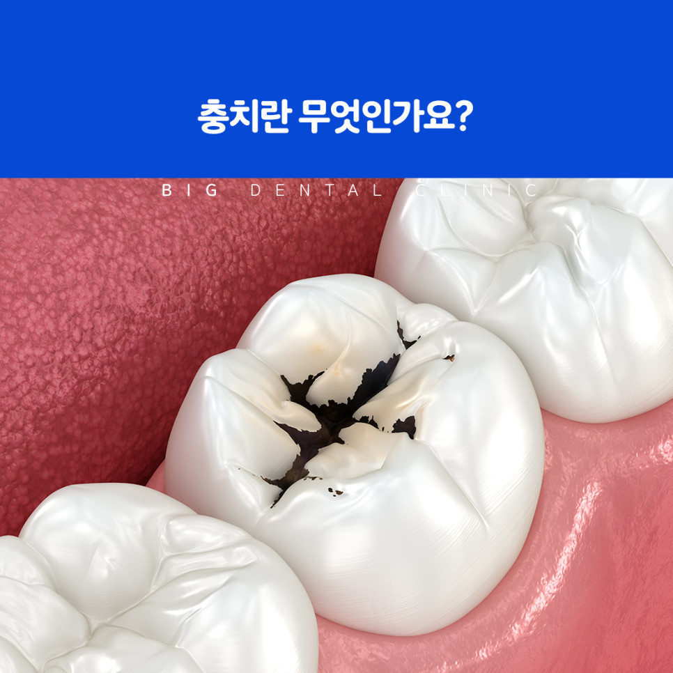 충치 원인과 구강 관리 설명 이미지