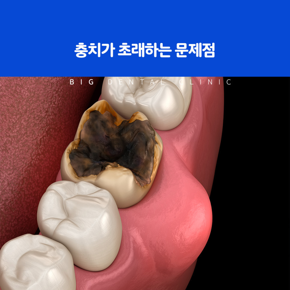 울산북구치과 선택 기준과 치료 후 관리 설명 이미지