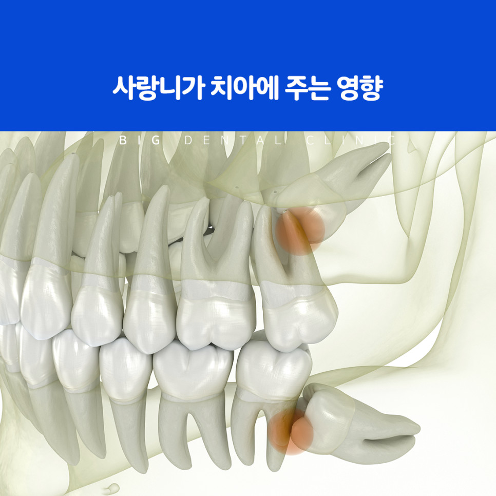 울산북구치과 사랑니가 10대 후반부터 20대 초반 위아래 네 개 나는 시기
