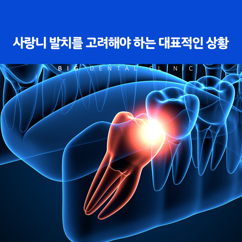 울산북구치과 사랑니가 잇몸뼈 공간 부족으로 비스듬히 나는 원인 확인