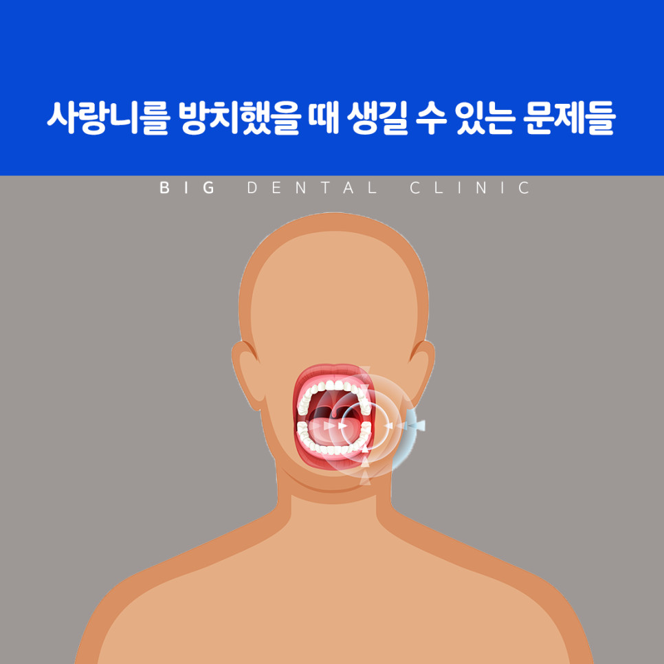 울산북구치과 사랑니가 옆 치아를 밀거나 잇몸 속에 묻힌 통증 상황