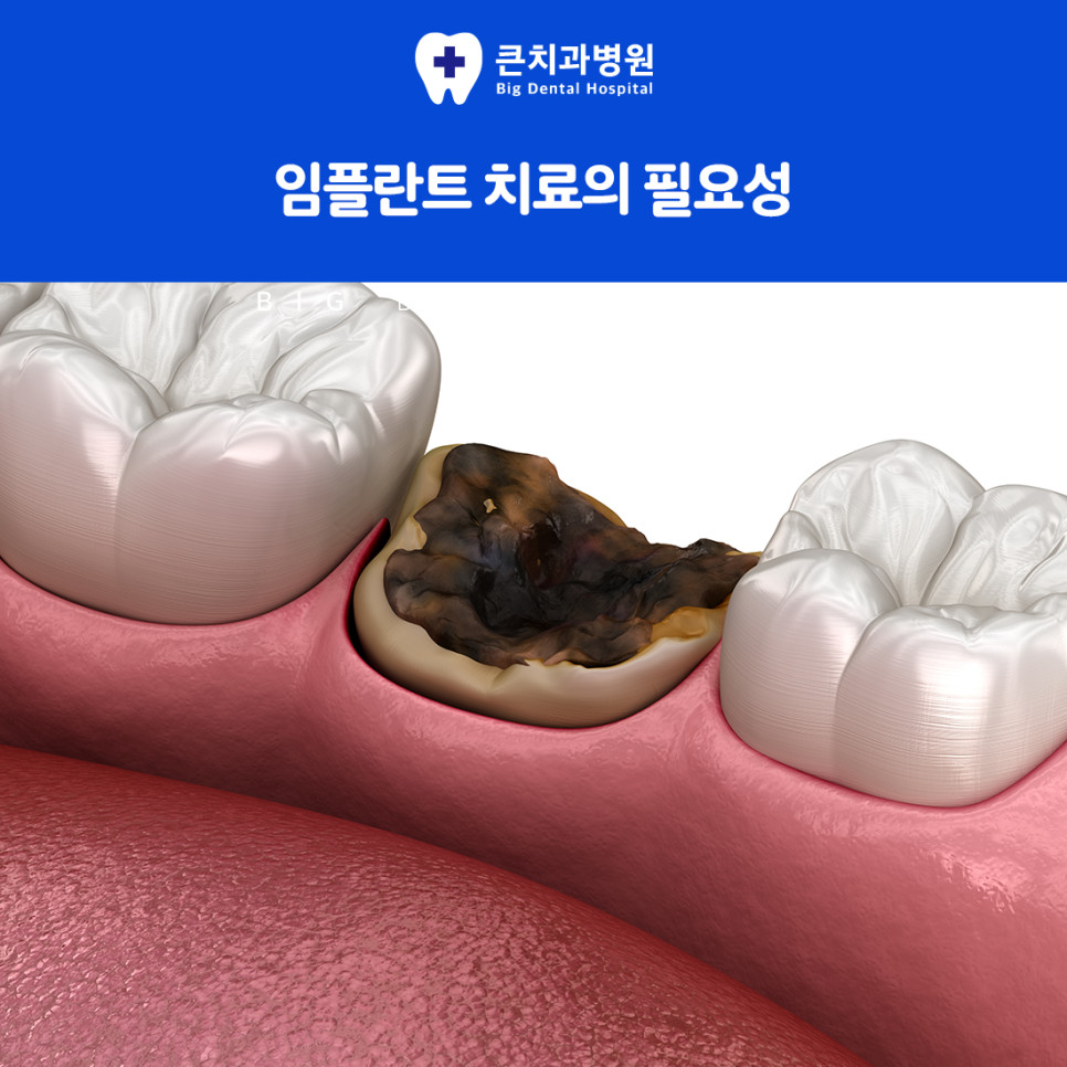 울산북구치과잘하는곳 임플란트 방법 잇몸뼈 인공치근 식립과 보철물 연결 과정