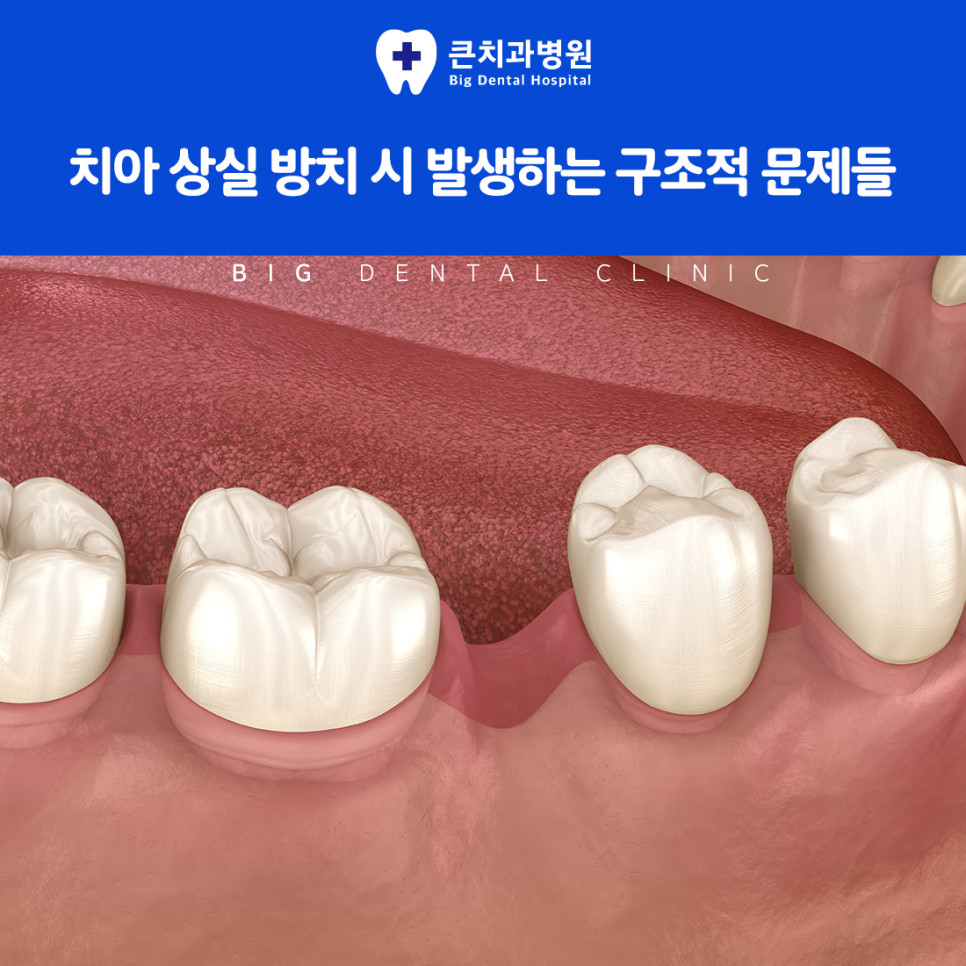 울산북구치과잘하는곳 임플란트 비교 틀니 브리지와 인접 치아 삭제 없는 고정식 장점