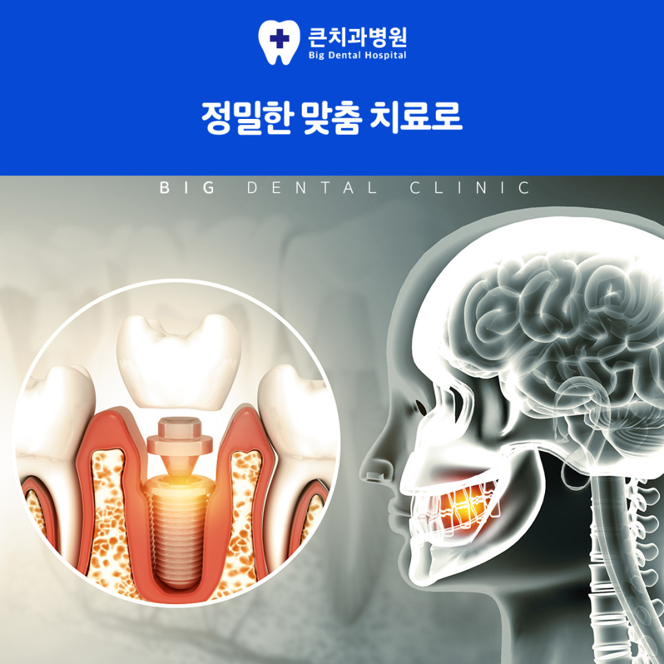 울산북구치과잘하는곳 임플란트 추천 충치 잇몸질환 외상 치아 상실 대상 치료 고려