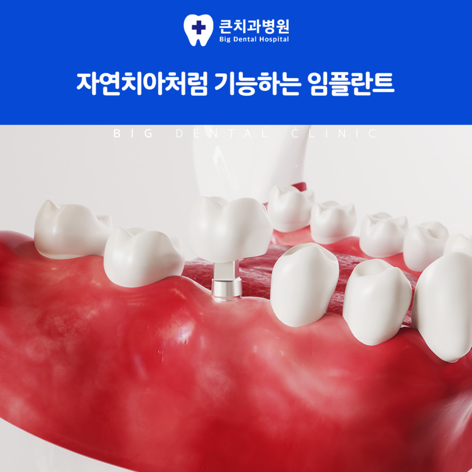 울산북구치과 임플란트 인공치근 식립으로 자연치아 유사 기능과 형태 회복 방법