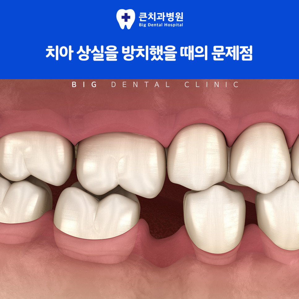 울산북구치과 임플란트 틀니보다 안정적이고 보철보다 주변 치아 부담 적은 차이