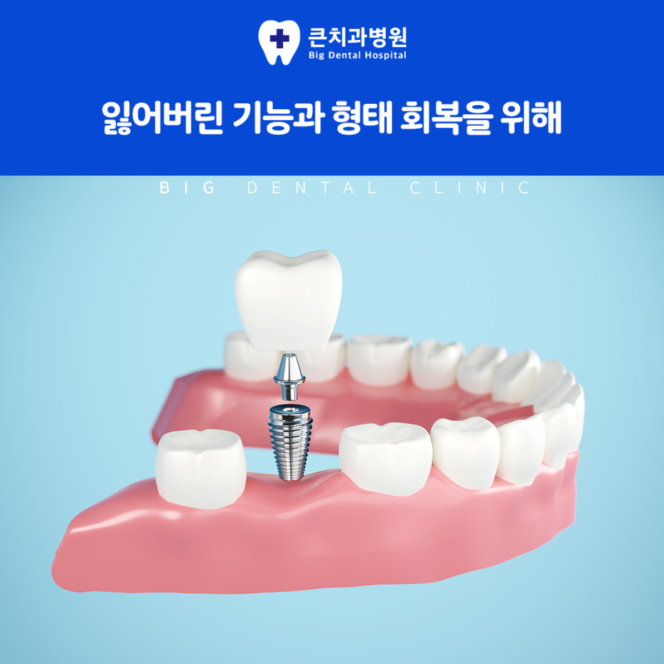 울산북구치과 임플란트 하나의 치아부터 여러 개 전체 치아 상실까지 적용 범위