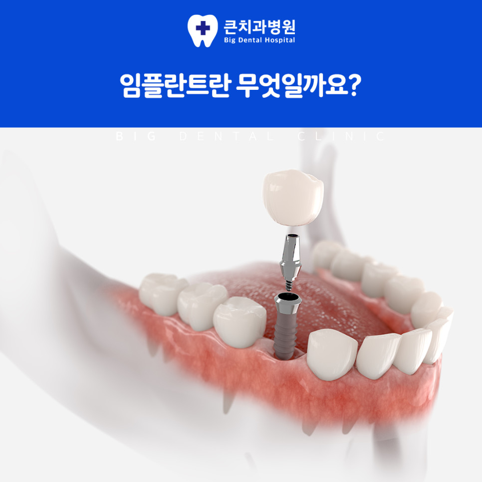 울산북구치과 손상된 치아가 자연 회복되지 않아 치료가 필요한 대표적 이유
