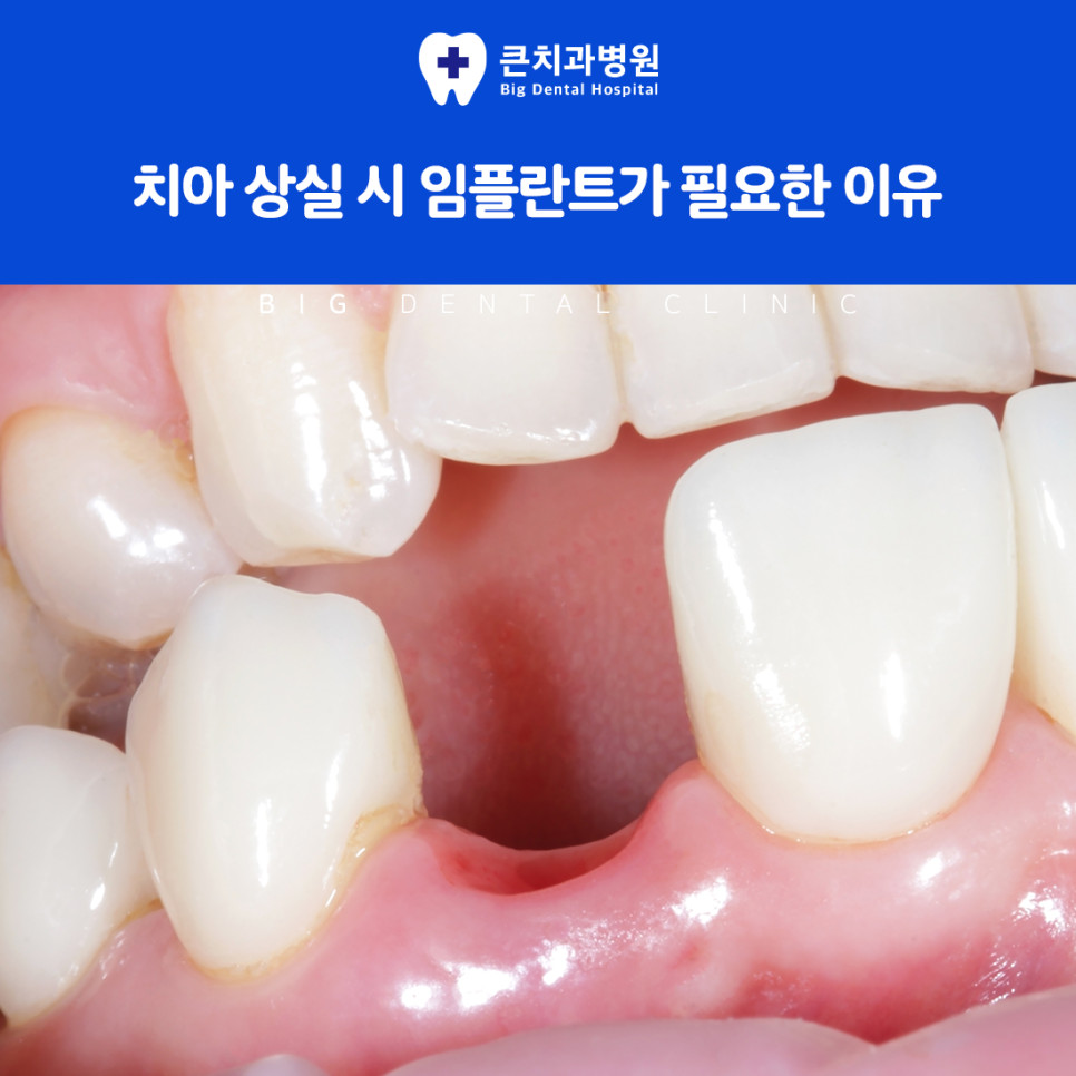울산북구치과 잇몸뼈 금속 구조물 임플란트 식립 방법과 인공치아 연결 과정