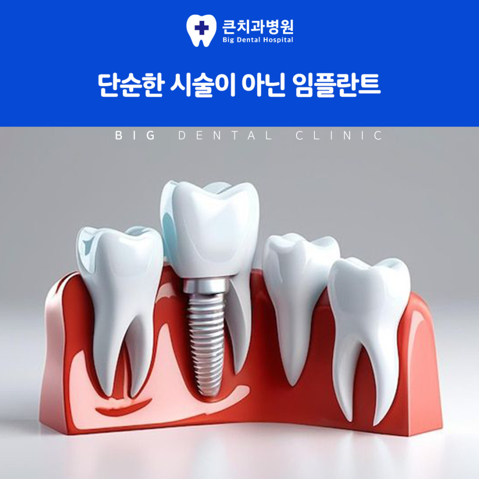 울산북구치과 자연치와 유사한 임플란트 저작 기능과 심미 만족감 핵심 비교