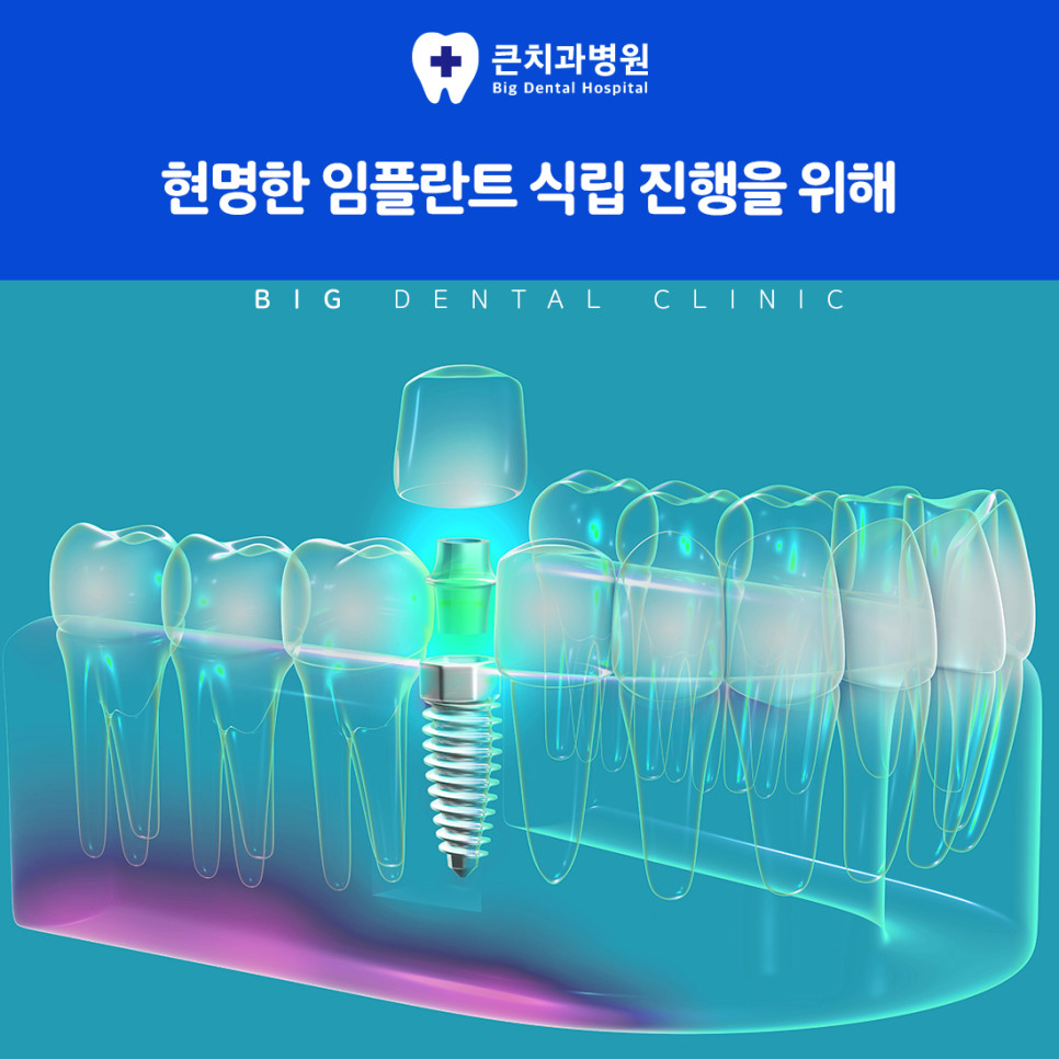 울산북구치과 심한 충치와 잇몸 질환으로 임플란트가 필요한 치료 대상 대표 상황