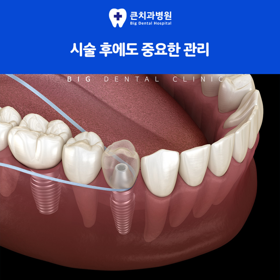 울산북구치과 외부 충격 치아 상실과 오래된 보철물 재치료 필요성 발생 상황