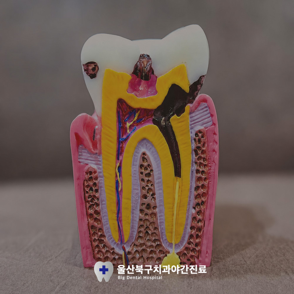 울산북구치과야간진료 충치 통증 전 시작해야 하는 치료 시기 송정동 인근 치과 안내