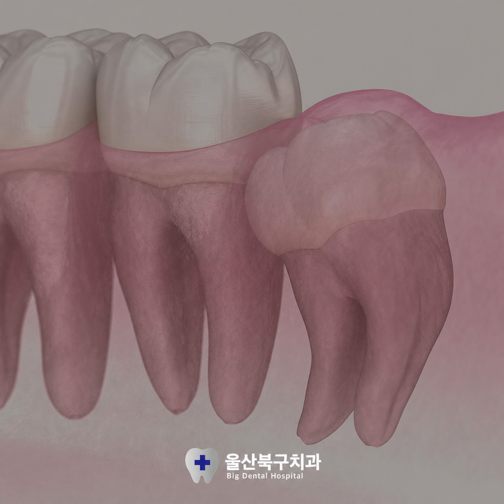 울산북구치과 사랑니 발치 전 성인기 치아 변화와 아픈 상태 방치 전 확인할 점