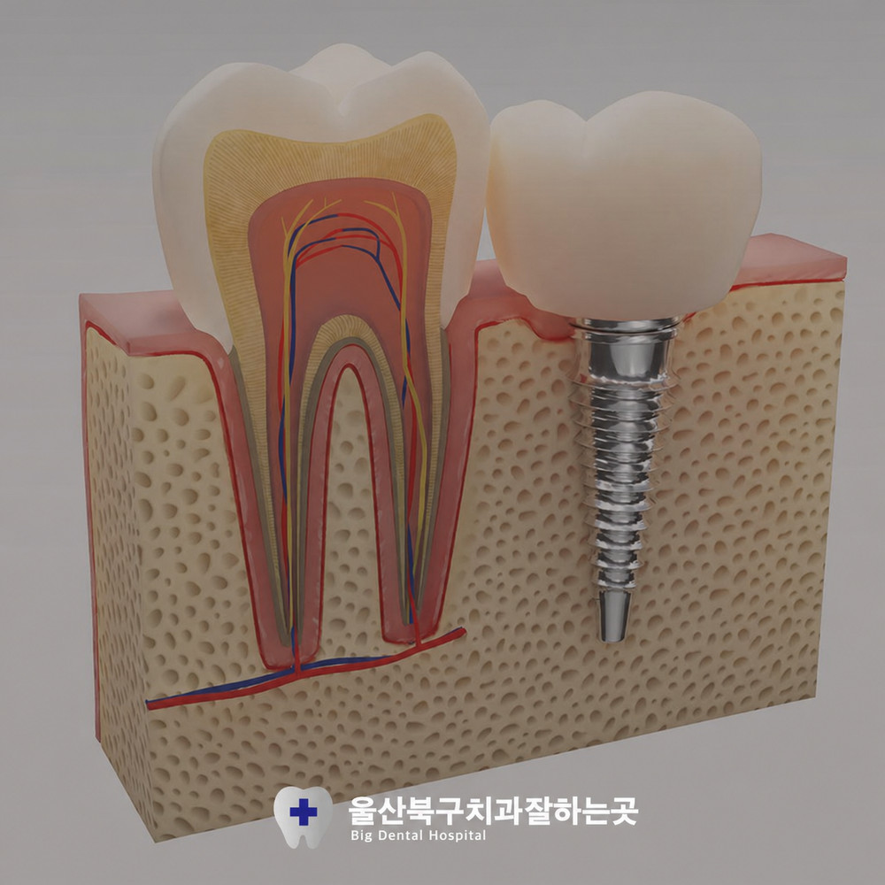 울산북구치과잘하는곳 치아 상실 후 저작력 심미성 회복 기준과 중장년층 관리 필요성