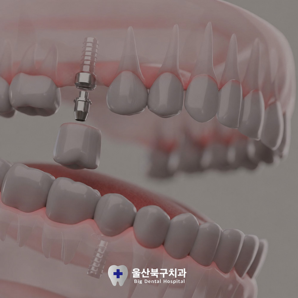 울산북구치과 임플란트 필요한 일상 속 치아 상실 원인과 구강 건강 대비 필요성