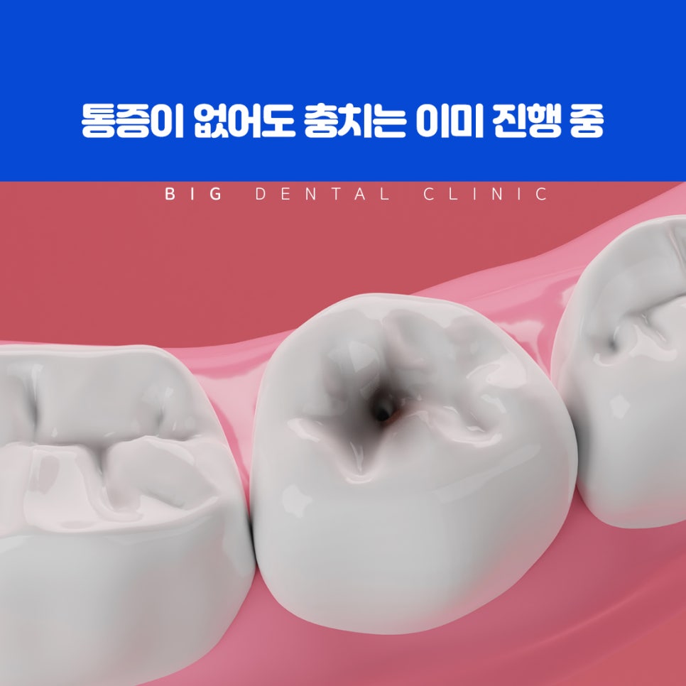 울산북구치과 설탕 탄수화물 산 생성과 법랑질 충치 진행 초기 원인과 관리