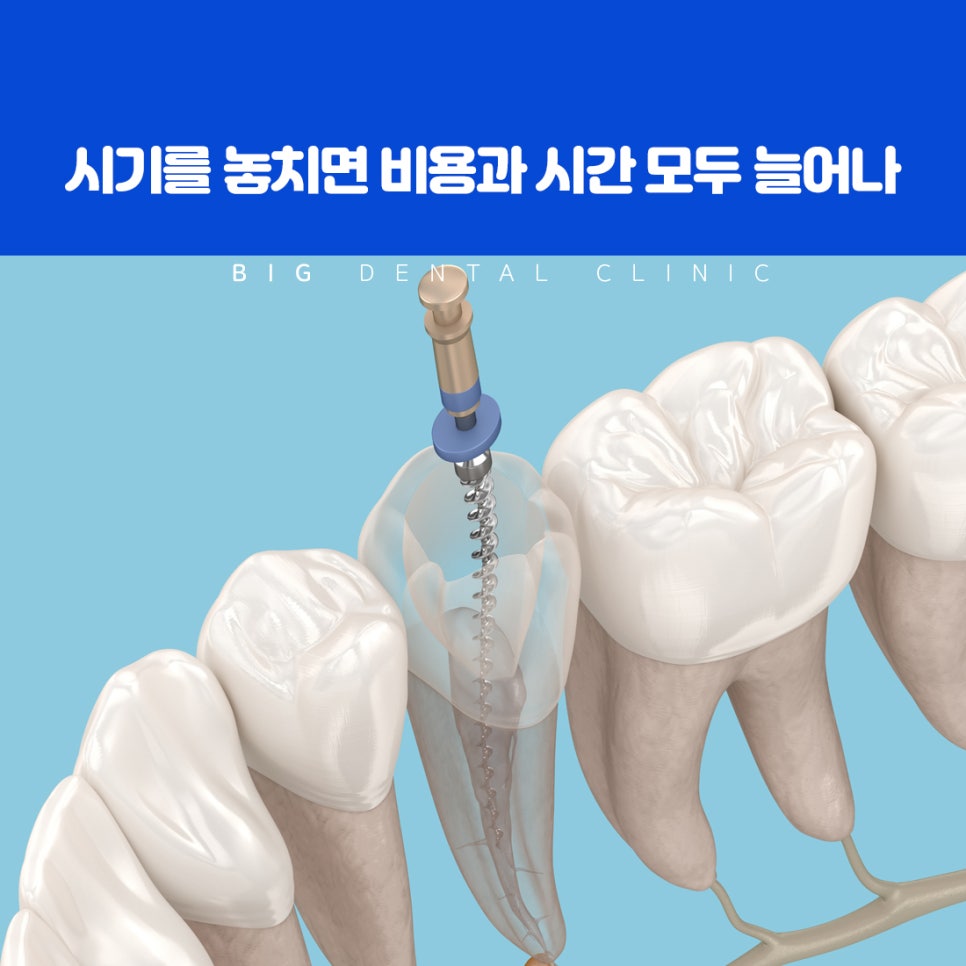 울산북구치과 통증 없는 초기 충치도 치아 보존 위해 정기 검진 필요한 이유